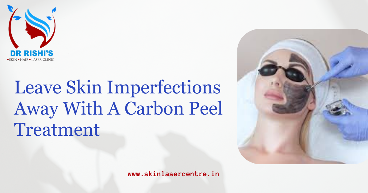 Leave Skin Imperfections Away With A Carbon Peel Treatment